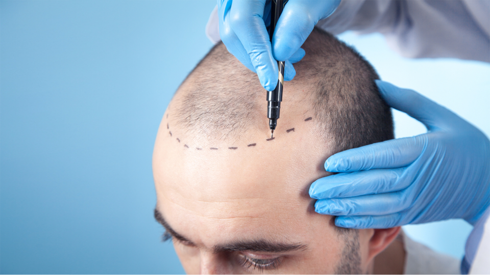 How Much does it Cost to Have A Hair Transplant in India?